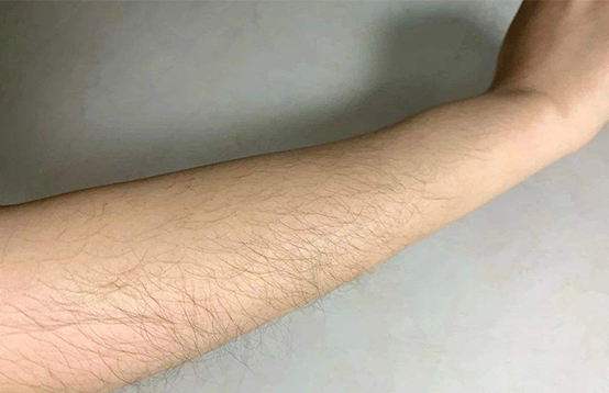如何選擇一款有效的脫毛儀