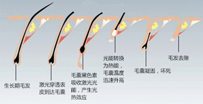 為什么有時(shí)候感覺家用脫毛儀效果不明顯？(圖2)